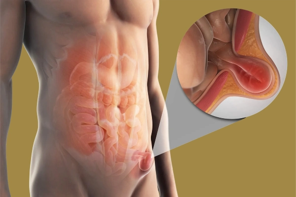 Inguinal Hernia