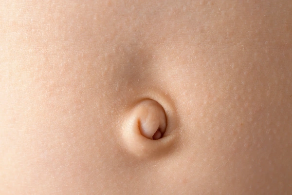 Umbilical Hernia